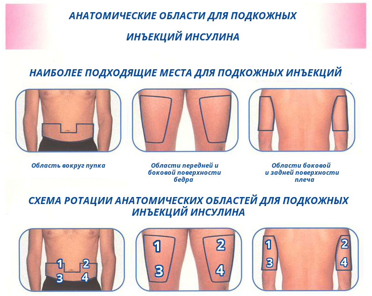 Области для введения инсулина